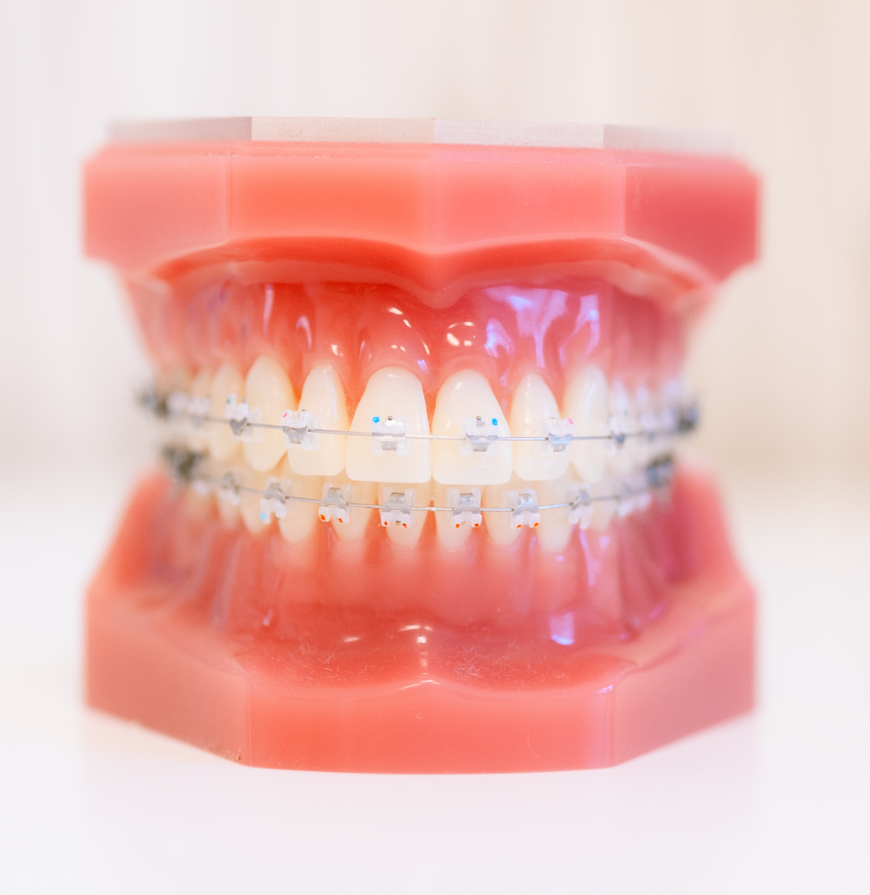 Traitement interception orthodontique